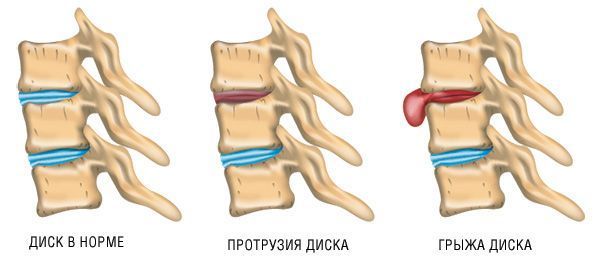 Повреждения межпозвонковых дисков