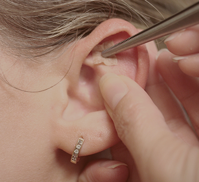 Микроиглотерапия