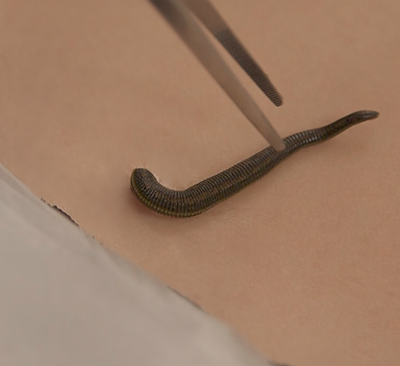 Гирудотерапия в гинекологии