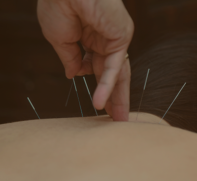 Иглоукалывание в гинекологии