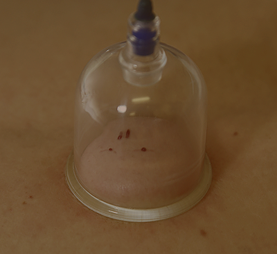 Кровопускание