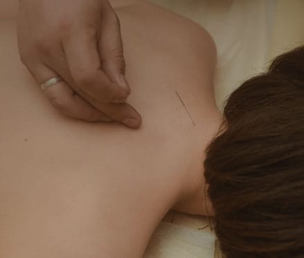 Иглоукалывание