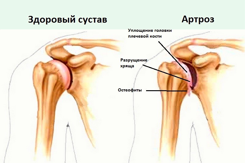 Симптомы артроза плечевого сустава