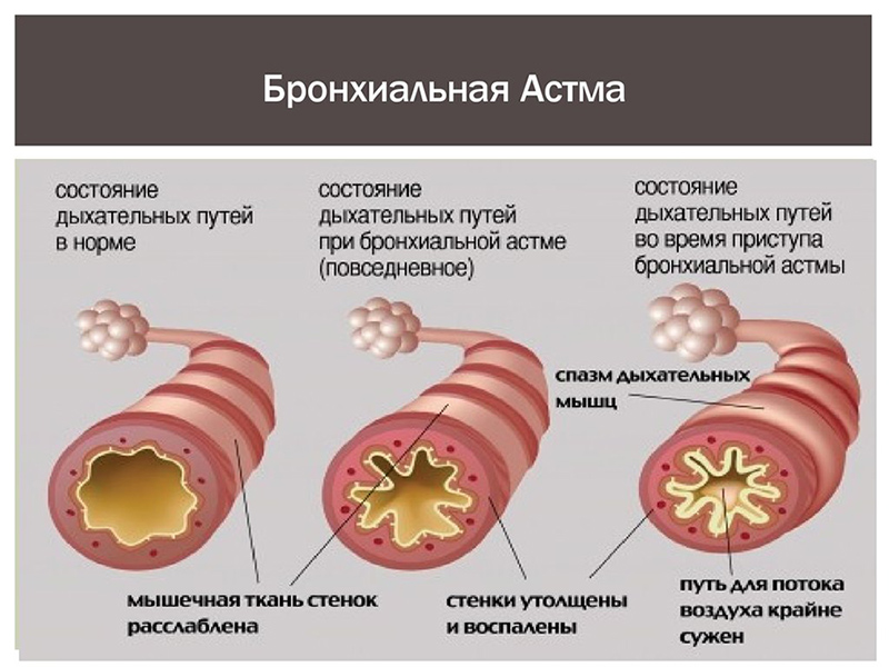 Диагностика бронхиальной астмы