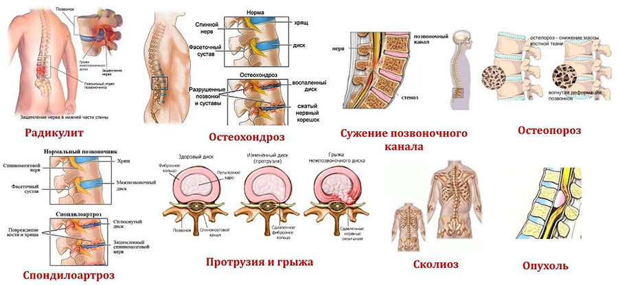 Причины болей в позвоночнике