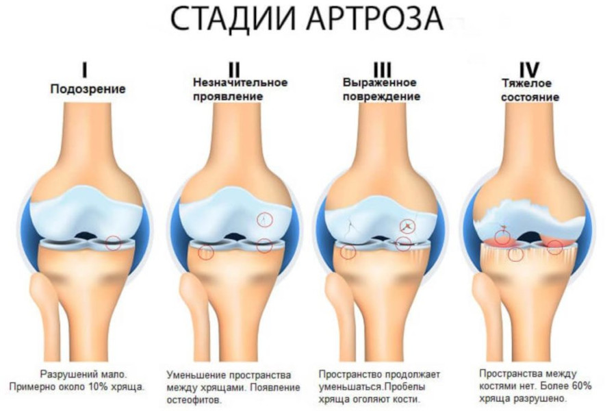 Артроз и степени годности к армии