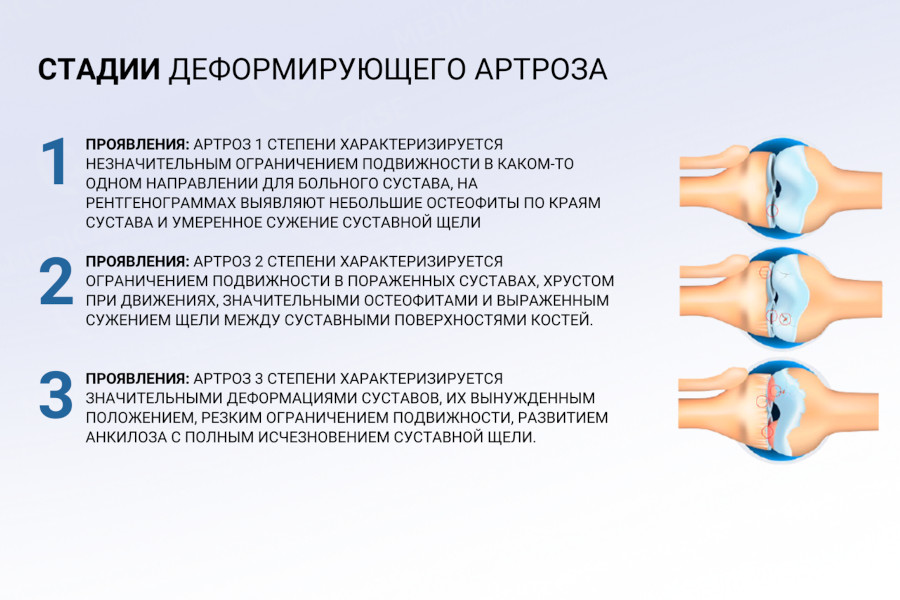 Стадии деформирующего артроза