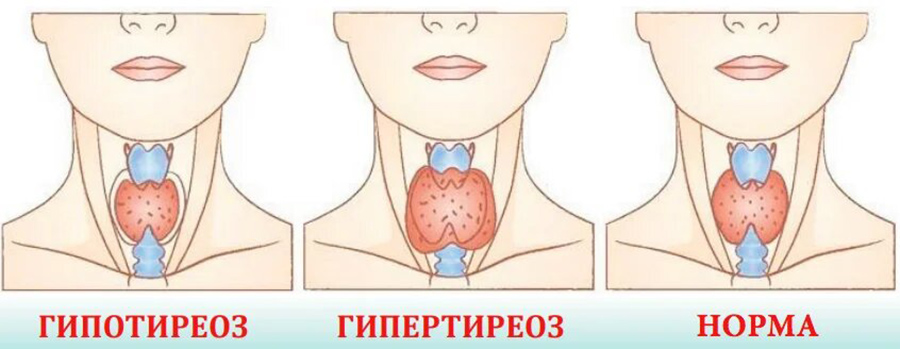 Диагностика гипотиреоза