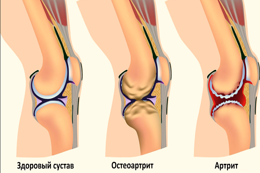Артрит коленного сустава
