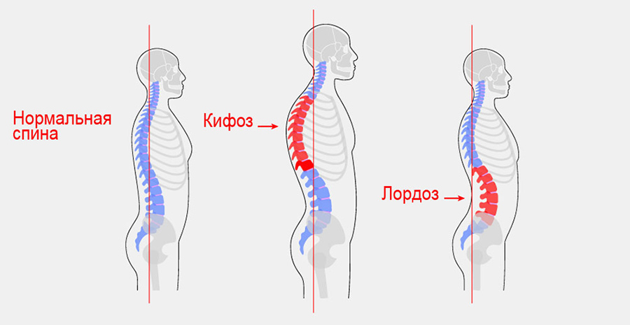 Углы изгиба позвоночника при кифозе