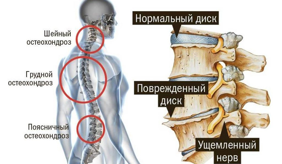 Остеохондроз отделов позвоночника