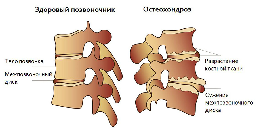 Остеохондроз позвоночника