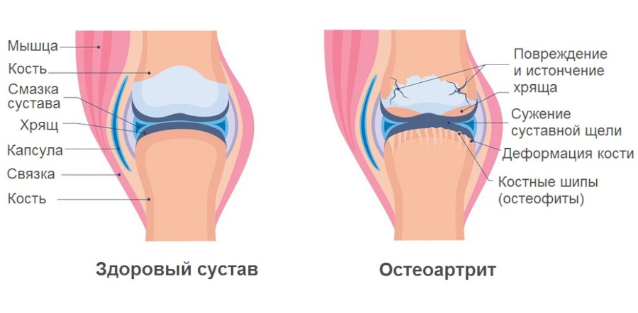 Сустав при остеострите