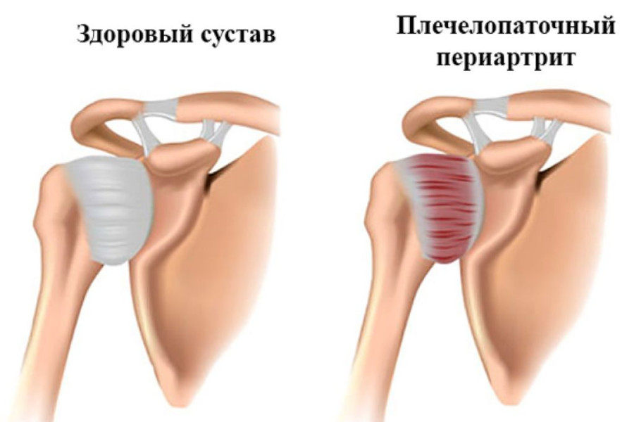 Плечелопаточный периартрит