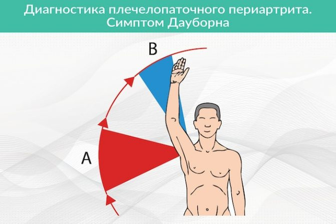 Диагностика плечелопаточного периатрита