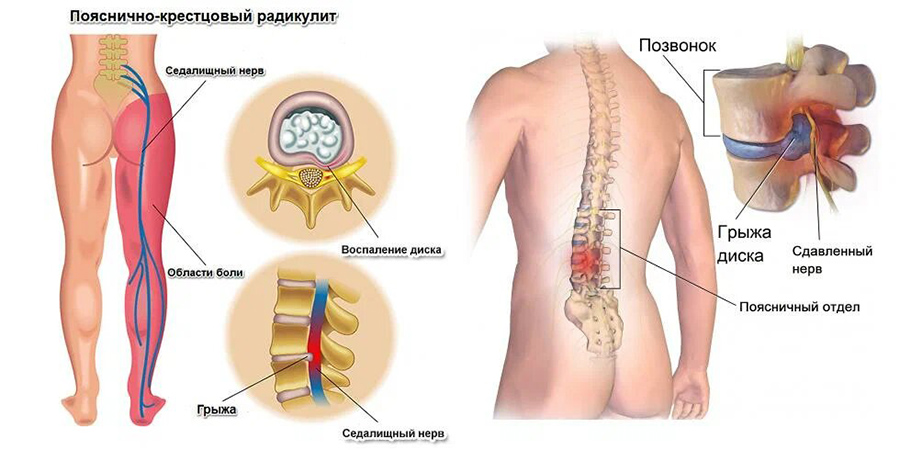 Радикулит - симптомы и лечение