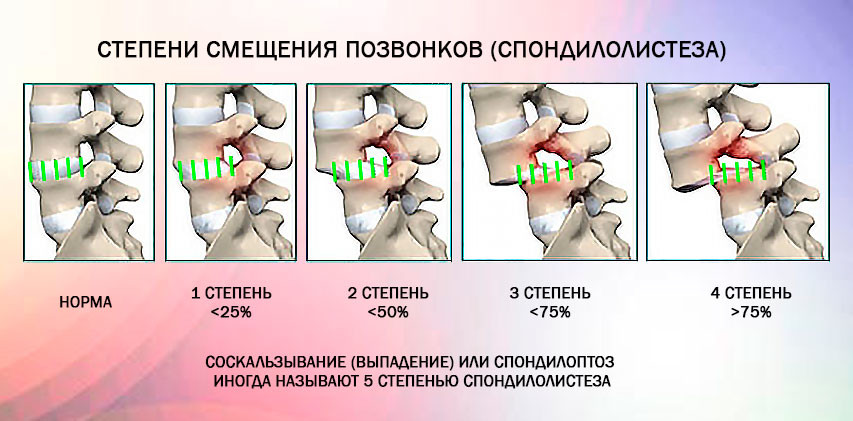 Степени смещения позвонков