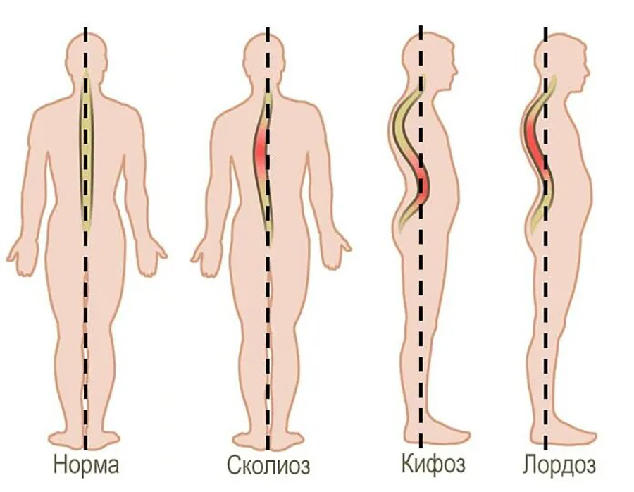 Виды сколиоза
