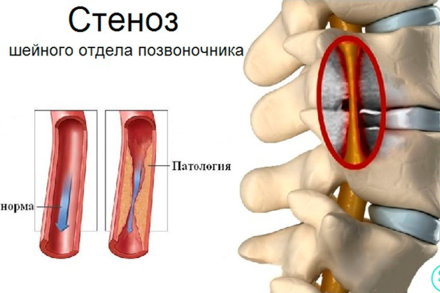 Сужение сосудов руки