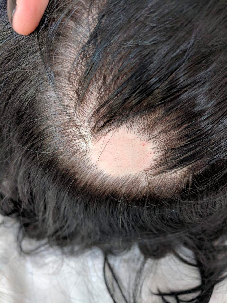 Выпадение волос, программа лечения выпадения волос