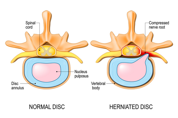 Грыжа позвоночника: симптомы и лечение