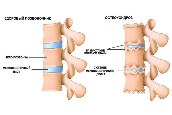 Остеохондроз поясничного отдела