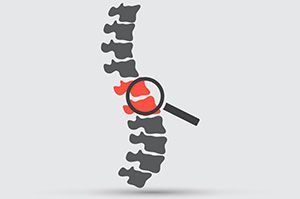 Что такое циркулярная и диффузная протрузии диска?