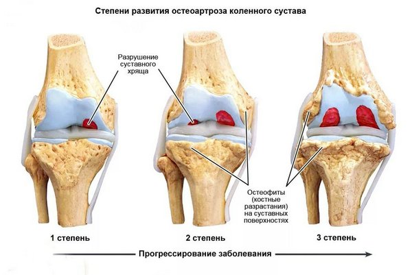 Артроз суставов: симптомы, виды и лечение