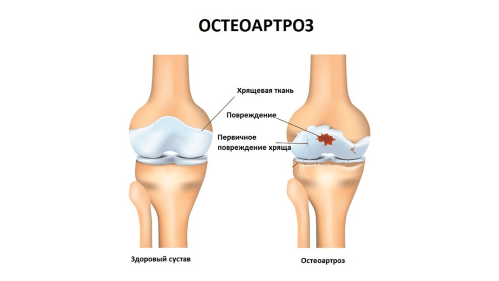 Поражение крупных суставов