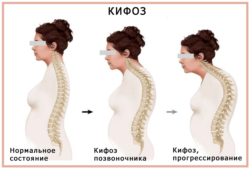 Кифоз позвоночника