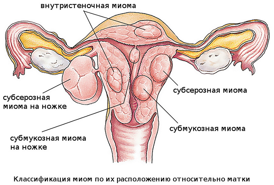 Классификация миом