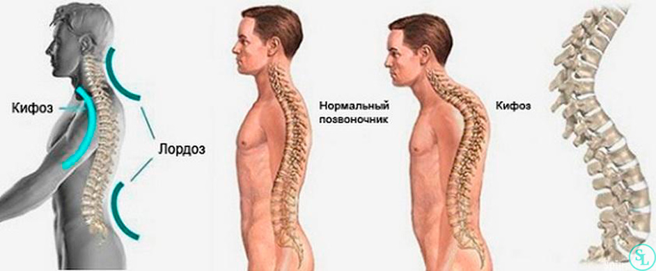 Кифоз позвоночника