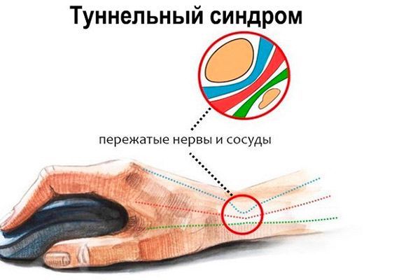 osteopaty-tunel-2.jpg