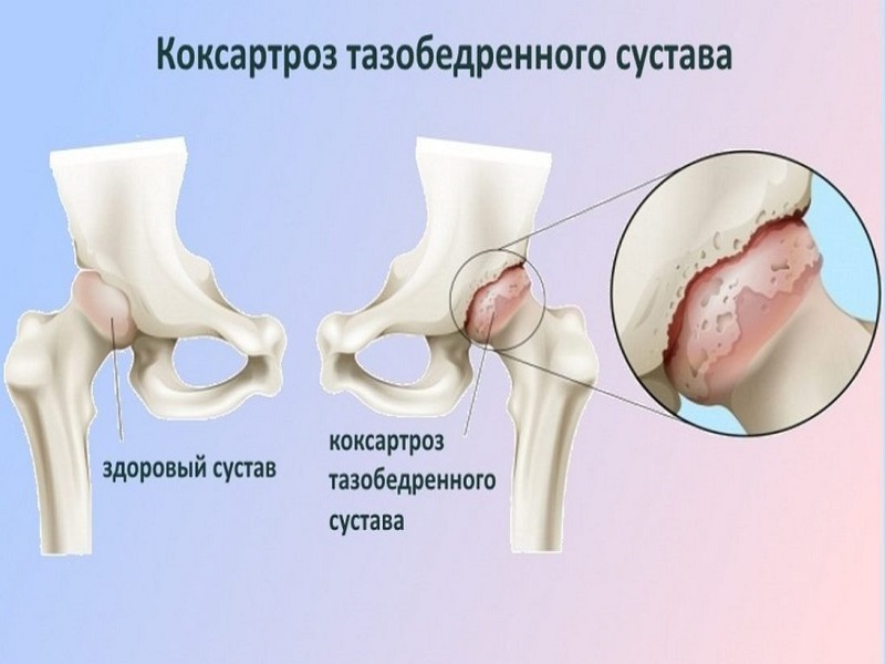 Какая боль при коксартрозе