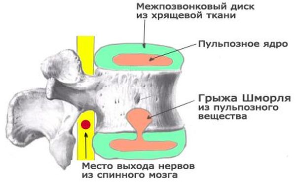 Грыжа Шморля