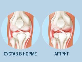 Артрит суставов