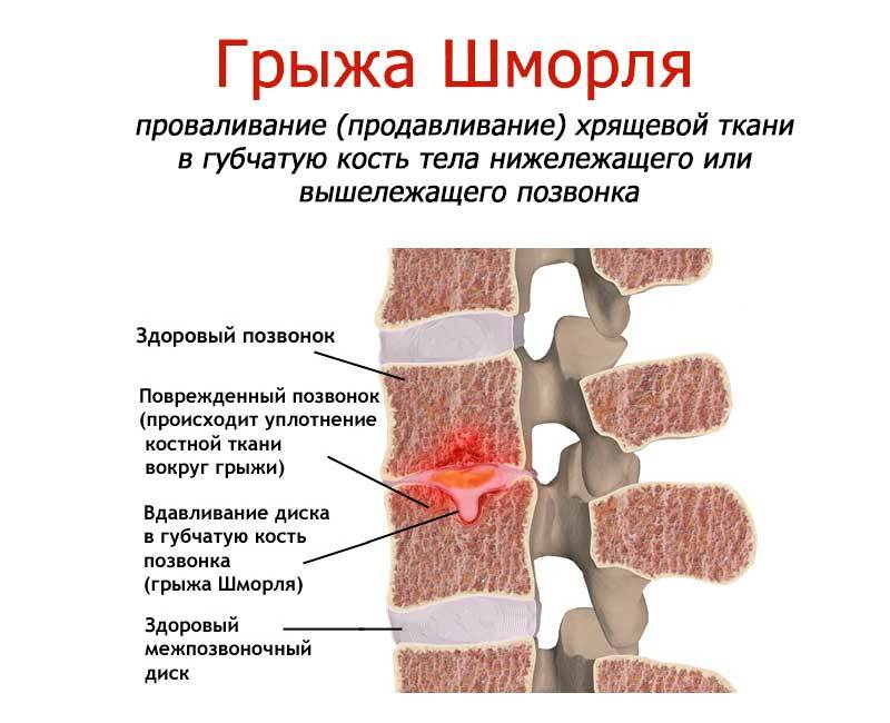 Усиление боли при кашле или чихании