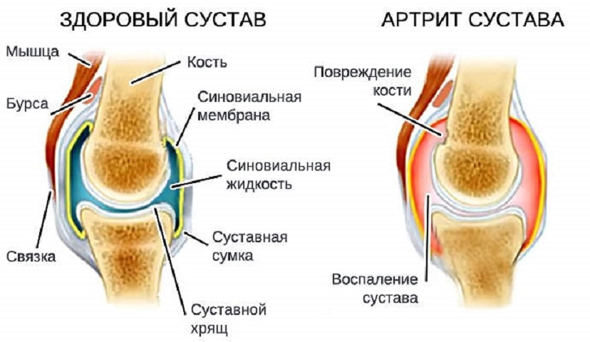 Артрит коленного сустава в домашних условиях