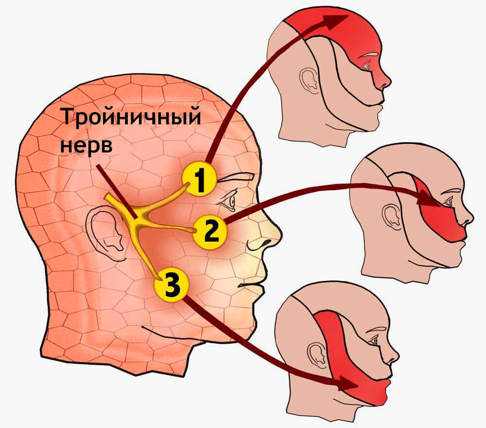 Невралгия тройничного нерва