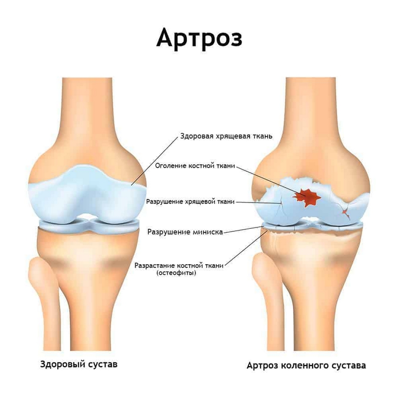 Артроз коленного сустава