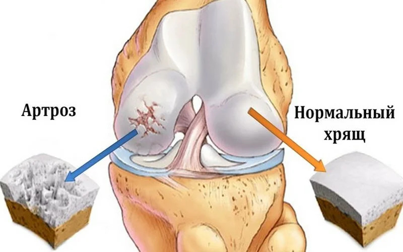 Артроз коленного сустава