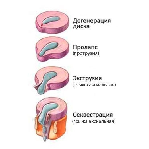 Какие виды грыж позвоночника существуют и чем они различаются?