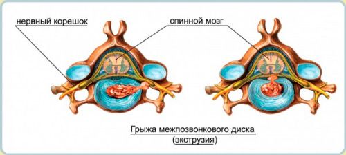 развитие грыжи диска