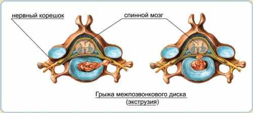 развитие грыжи диска развитие грыжи диска