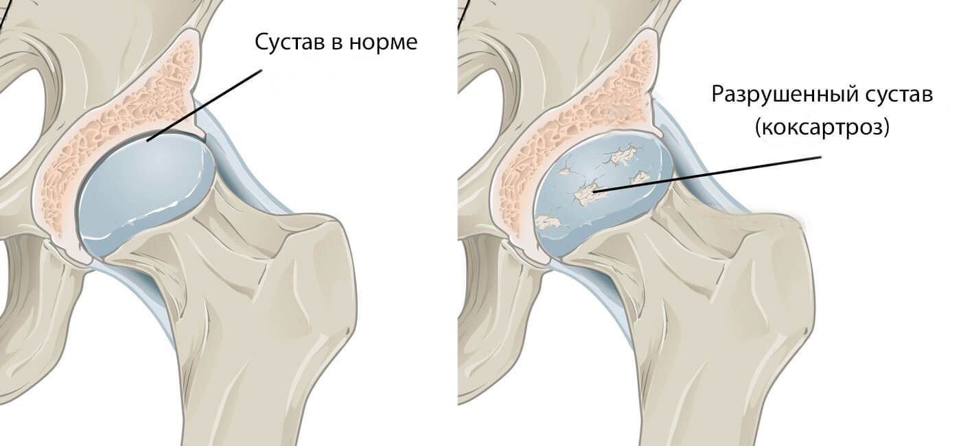 Коксартроз (артроз тазобедренных суставов): симптомы и лечение