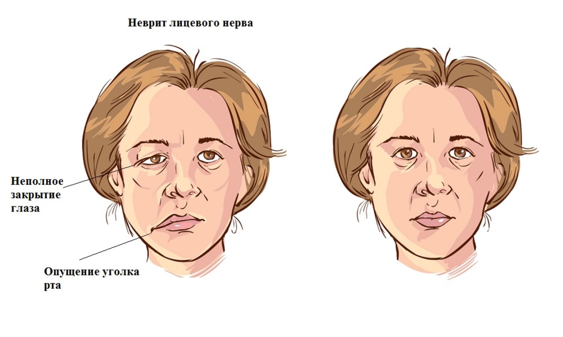 Неврит лицевого нерва: симптомы и лечение